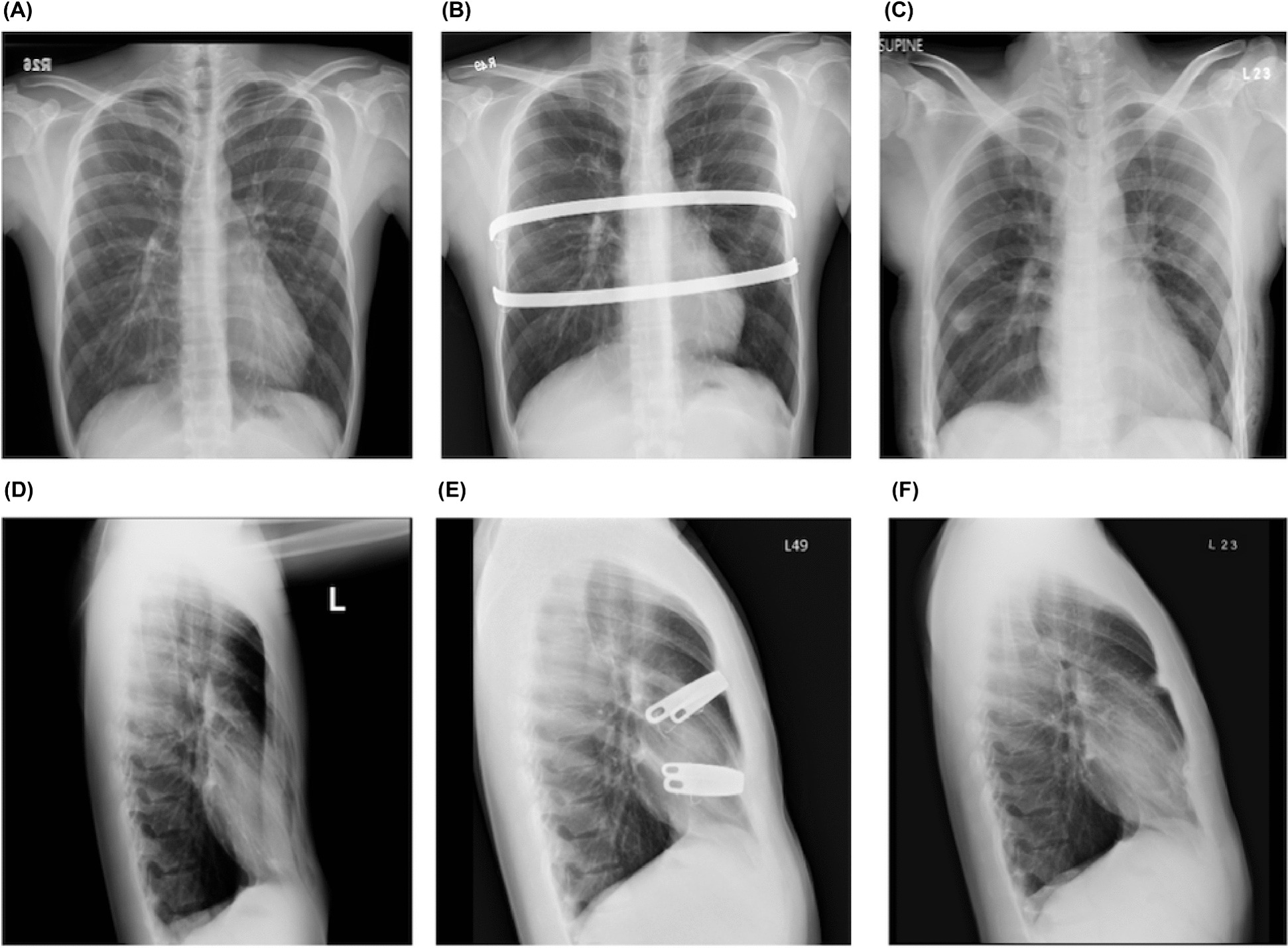 Impact of delayed removal of pectus bar on outcomes following Nuss repair: a retrospective analysis