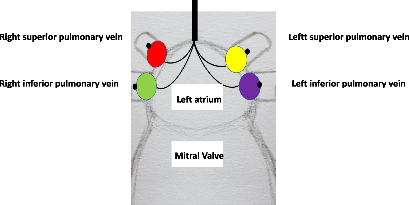 Develop of endocavitary suction device for MiECC on minimally invasive mitral valve surgery