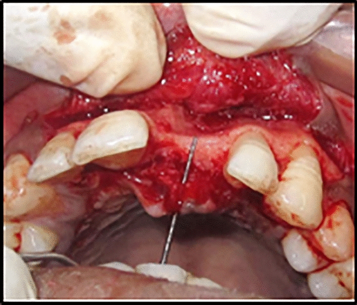 Reconstructive Surgery with Autogenous Chin Block Graft for Esthetic Rehabilitation of Deficient Anterior Maxillary Region