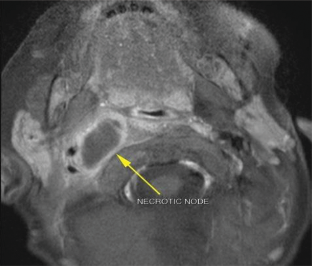 Use of Navigation System in the Management of Deep Neck Space Infection—A Case Report