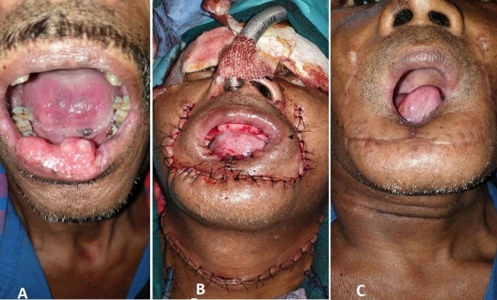 Bilateral Karapandzic Flap, a Saviour for Subtotal Lower Lip Reconstruction
