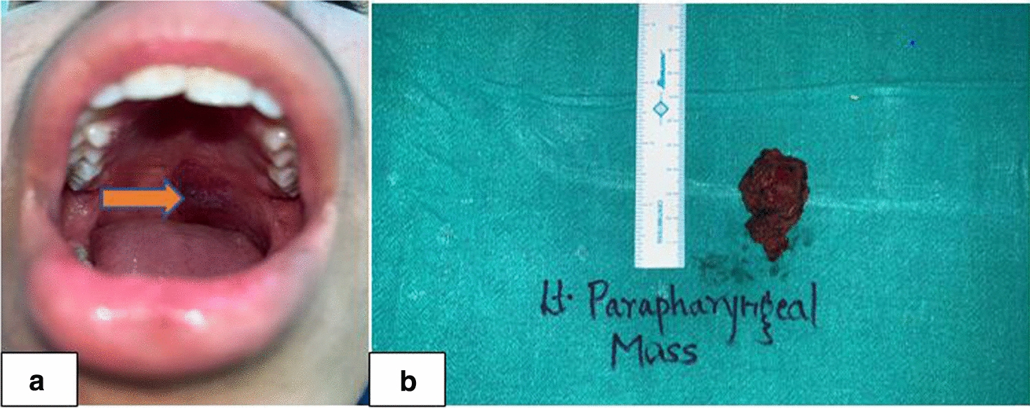 Transoral Robotic Surgery for a Rare Case of Venolymphatic Malformation in Parapharyngeal Space