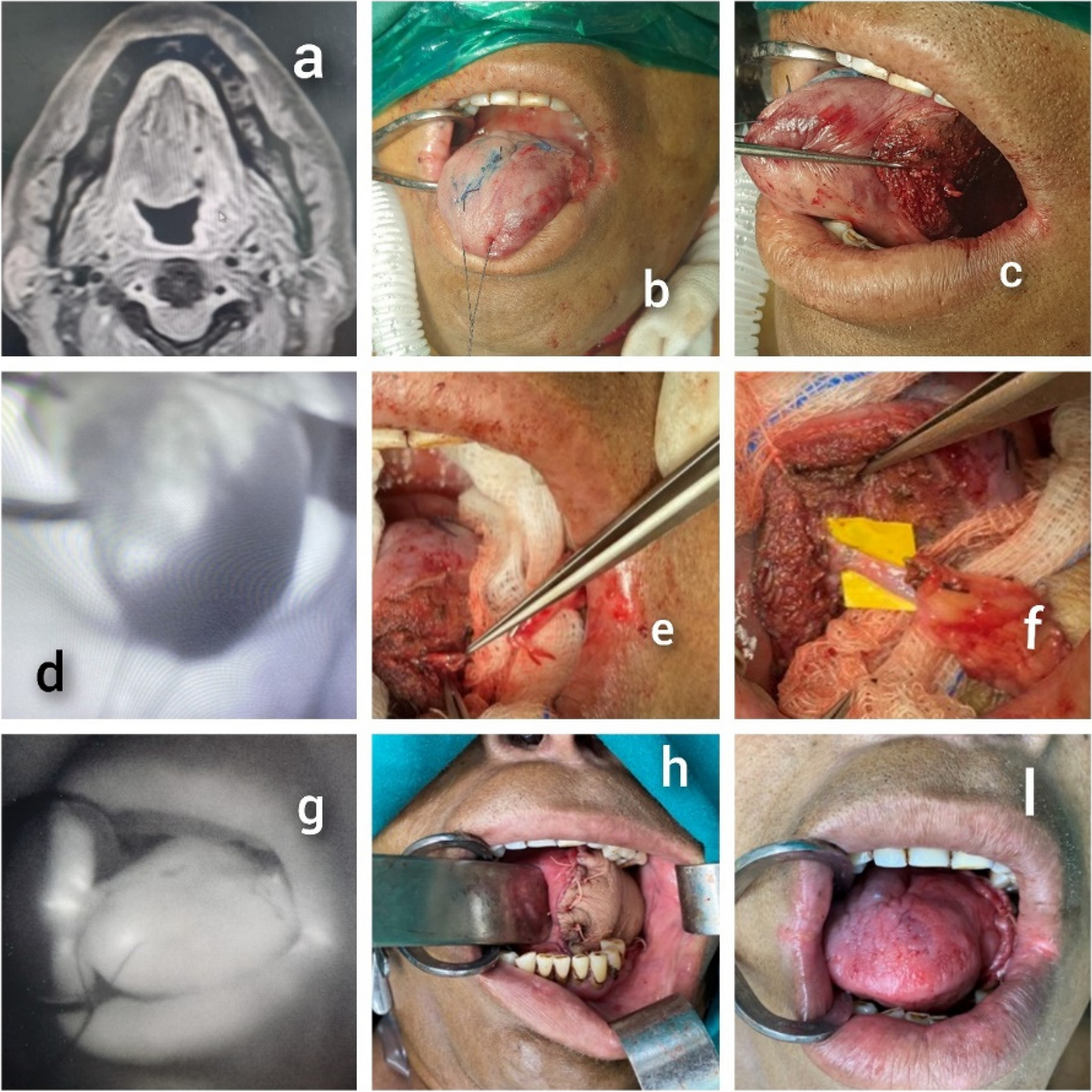 Flow-Through Radial Artery Forearm Flap for Tongue Revascularization After Excision of Base of Tongue Malignancies