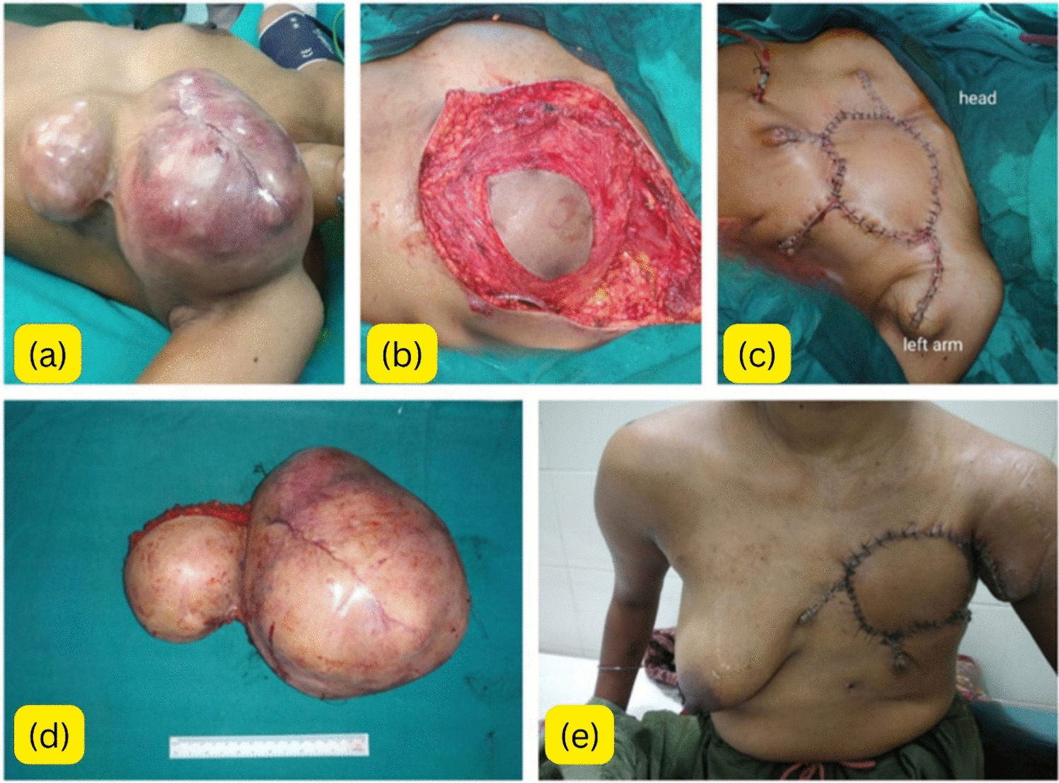 Phyllodes Tumors of the Breast—Experience in a Tertiary Care Center