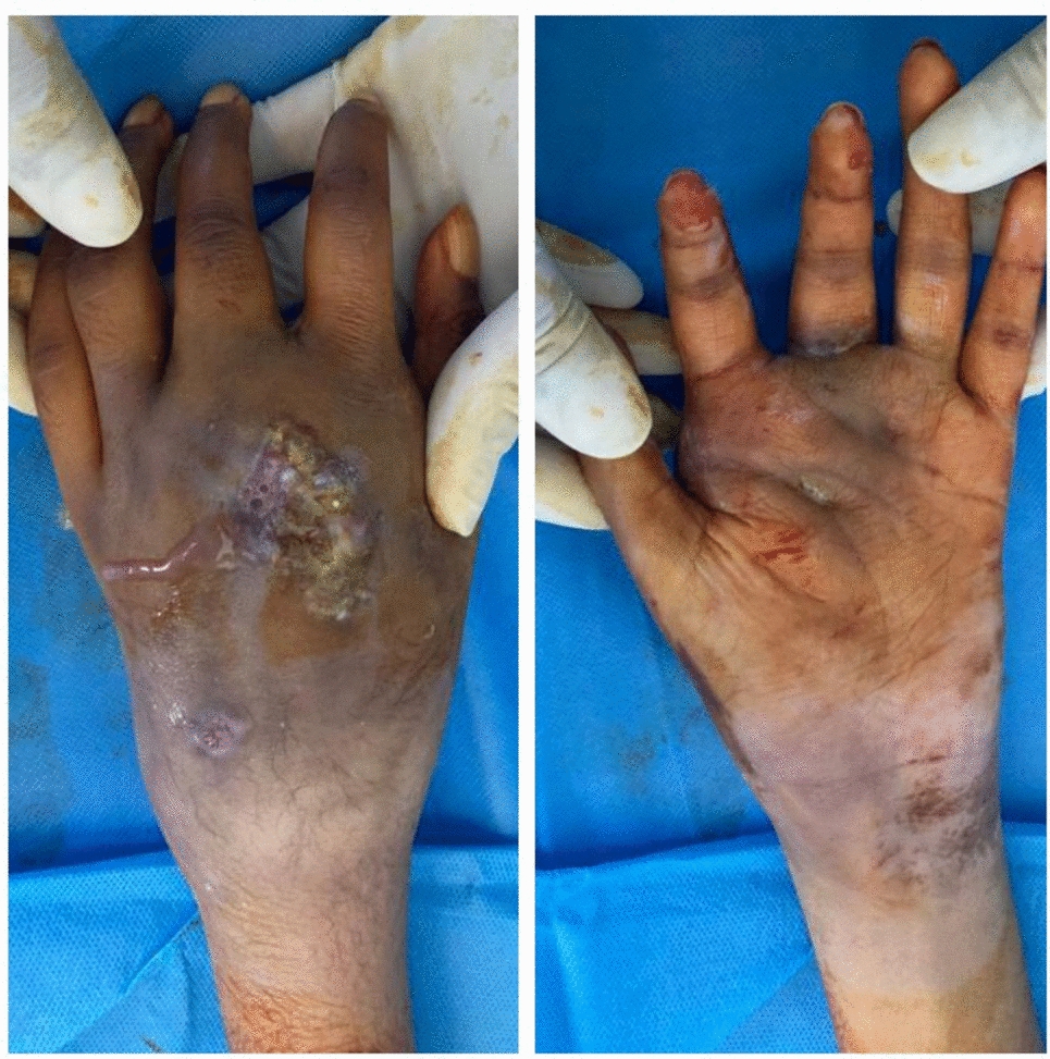 Multiple Metacarpal Loss Secondary to Tuberculous Dactylitis: Challenges and Management: A Case Report