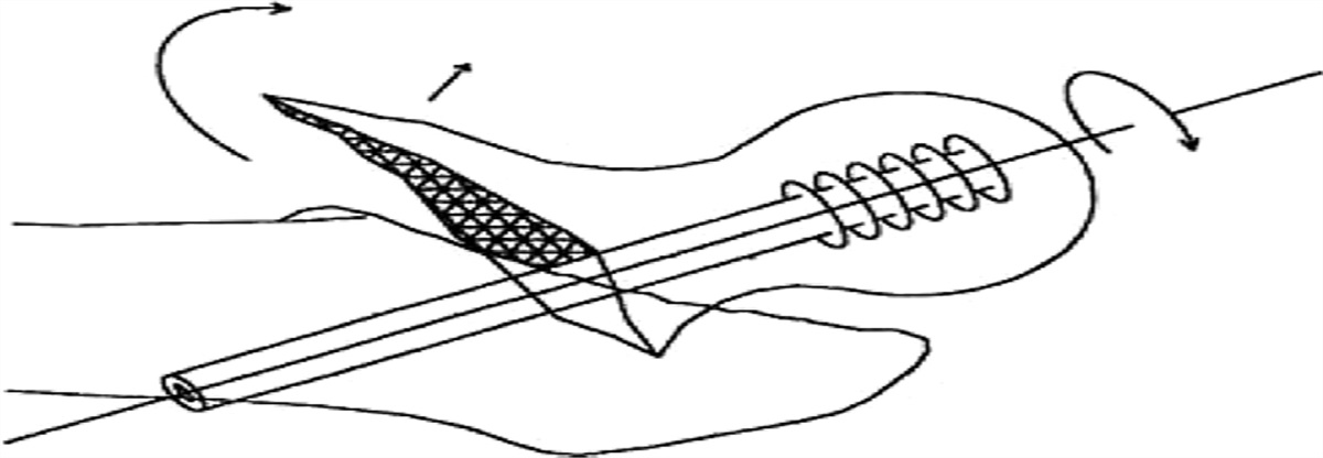 Provisional Reduction to Avoid the Wedge Effect and Control Rotational Deforming Force During Cephalomedullary Nail Insertion for Unstable Intertrochanteric and Basicervical Femoral Neck Fractures: A Novel Surgical Technique