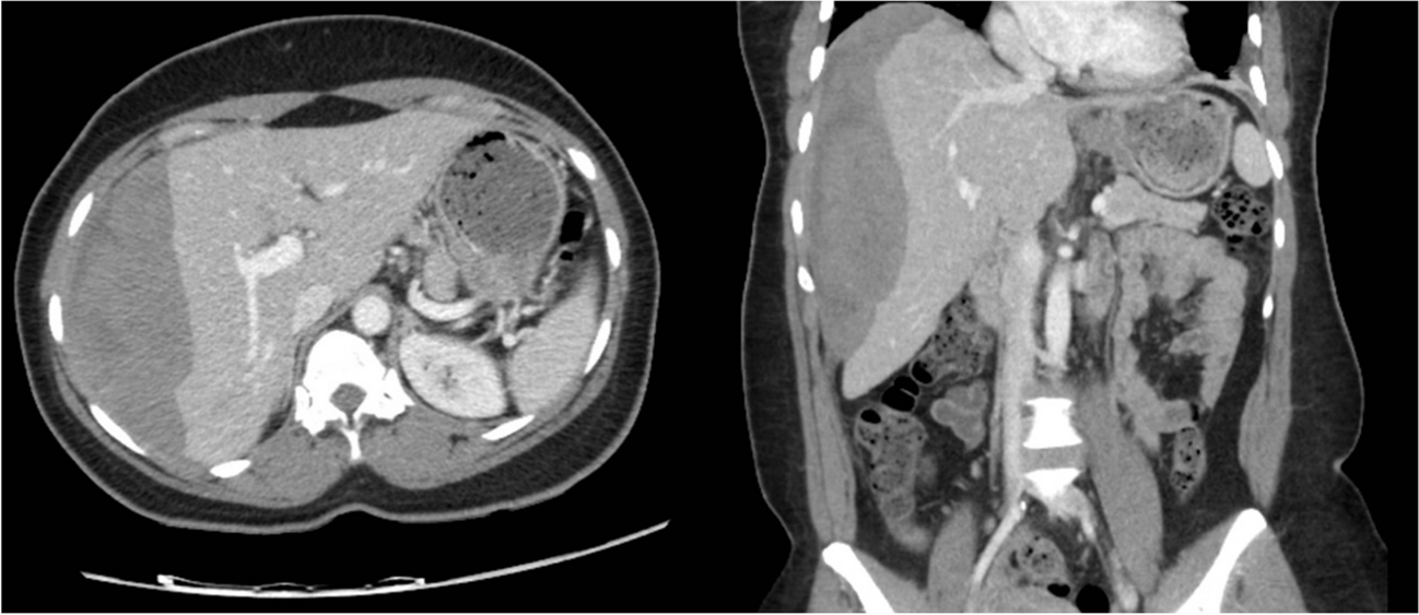 Spontaneous idiopathic liver hemorrhage: a systematic review of a rare entity