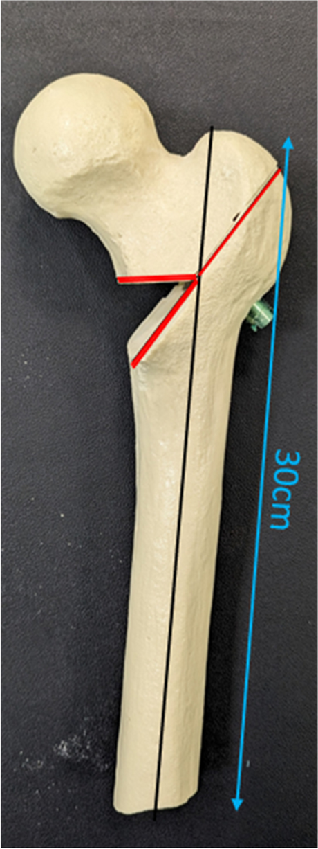 Efficacy of poller screw in addition to lag screw in the treatment of intertrochanteric fractures with proximal femoral nail: a biomechanical evaluation