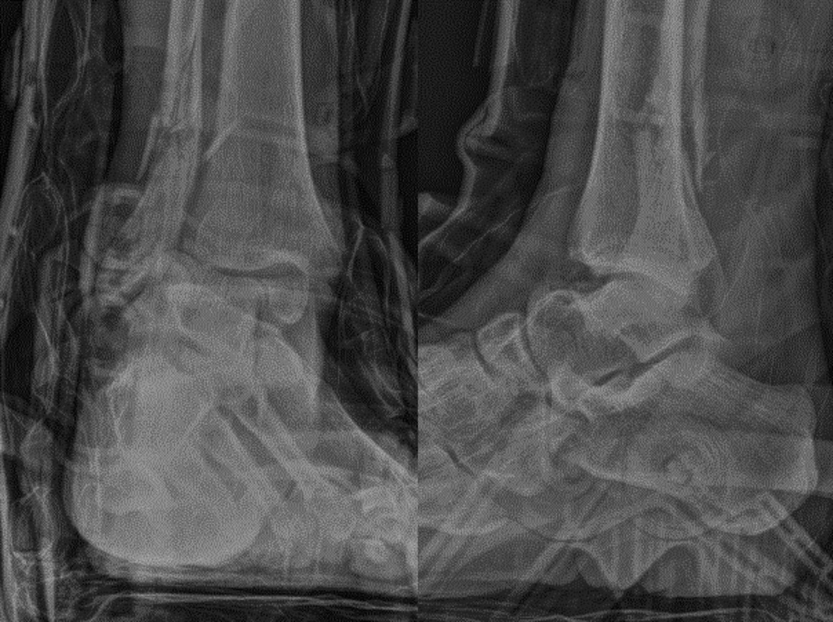 Primary Screw Fixation of the Medial Malleolus in Highly Unstable Ankle Fracture-dislocations as an Alternative to Temporary Ankle-spanning External Fixation