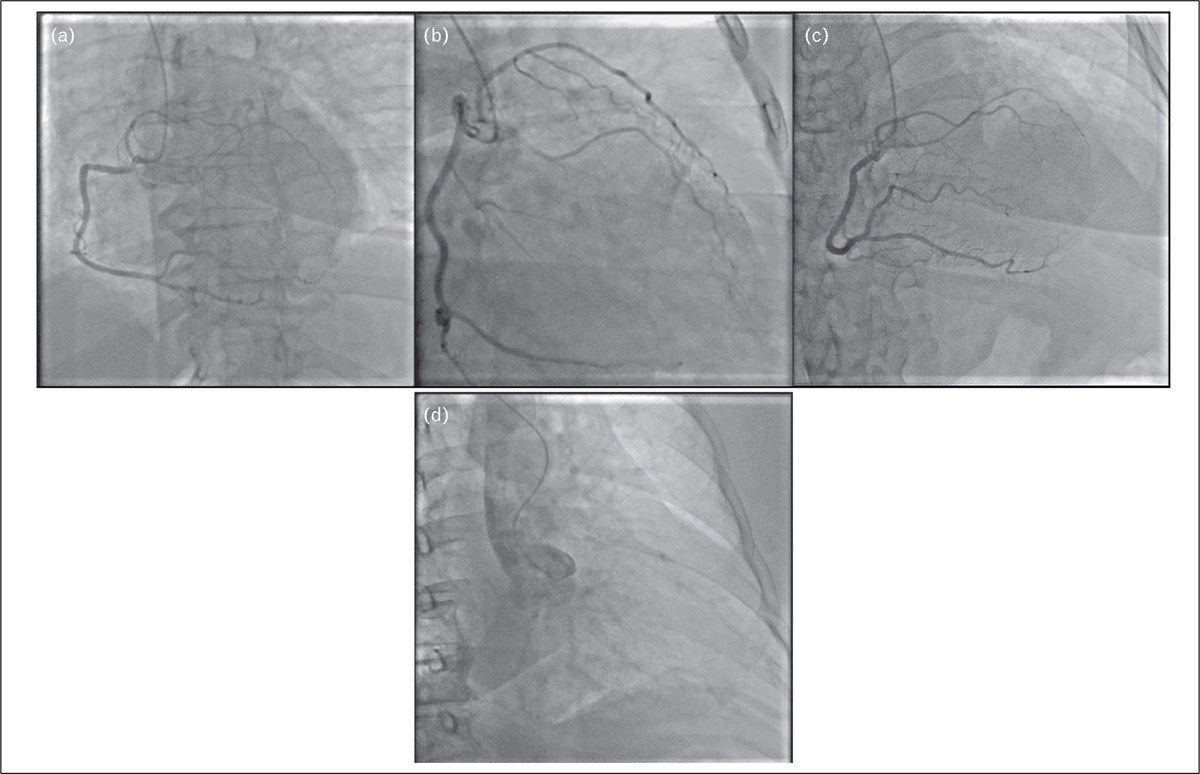 Anomalous origin of the coronary arteries: a brief summary for clinical practice