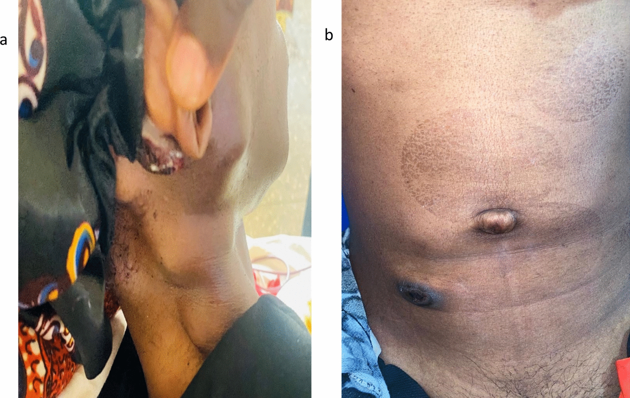 Disseminated AIDS-associated Kaposi sarcoma without cutaneous involvement: a case report and review of literature