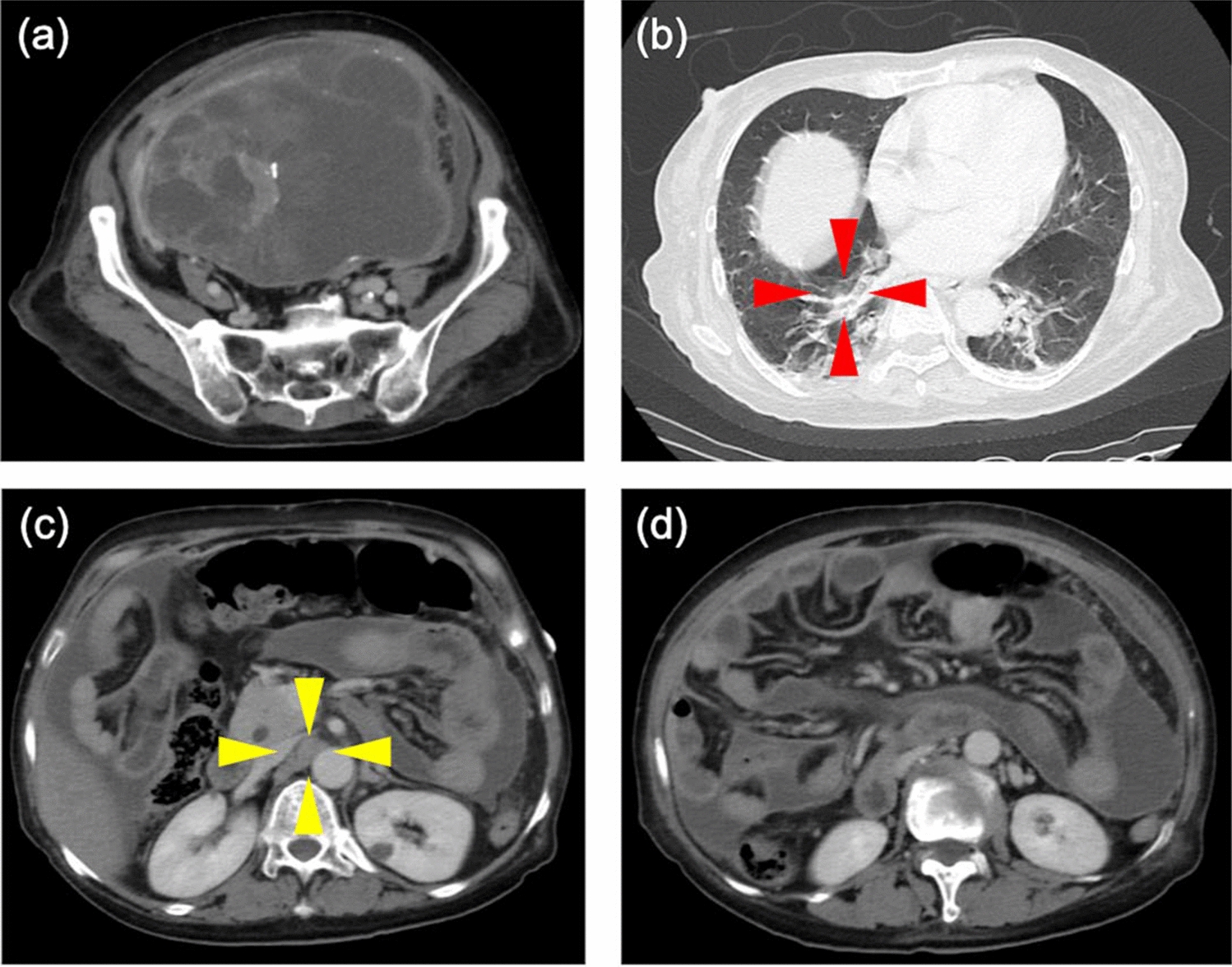 Coexistence of ovarian cancer and peritoneal tuberculosis: a case report