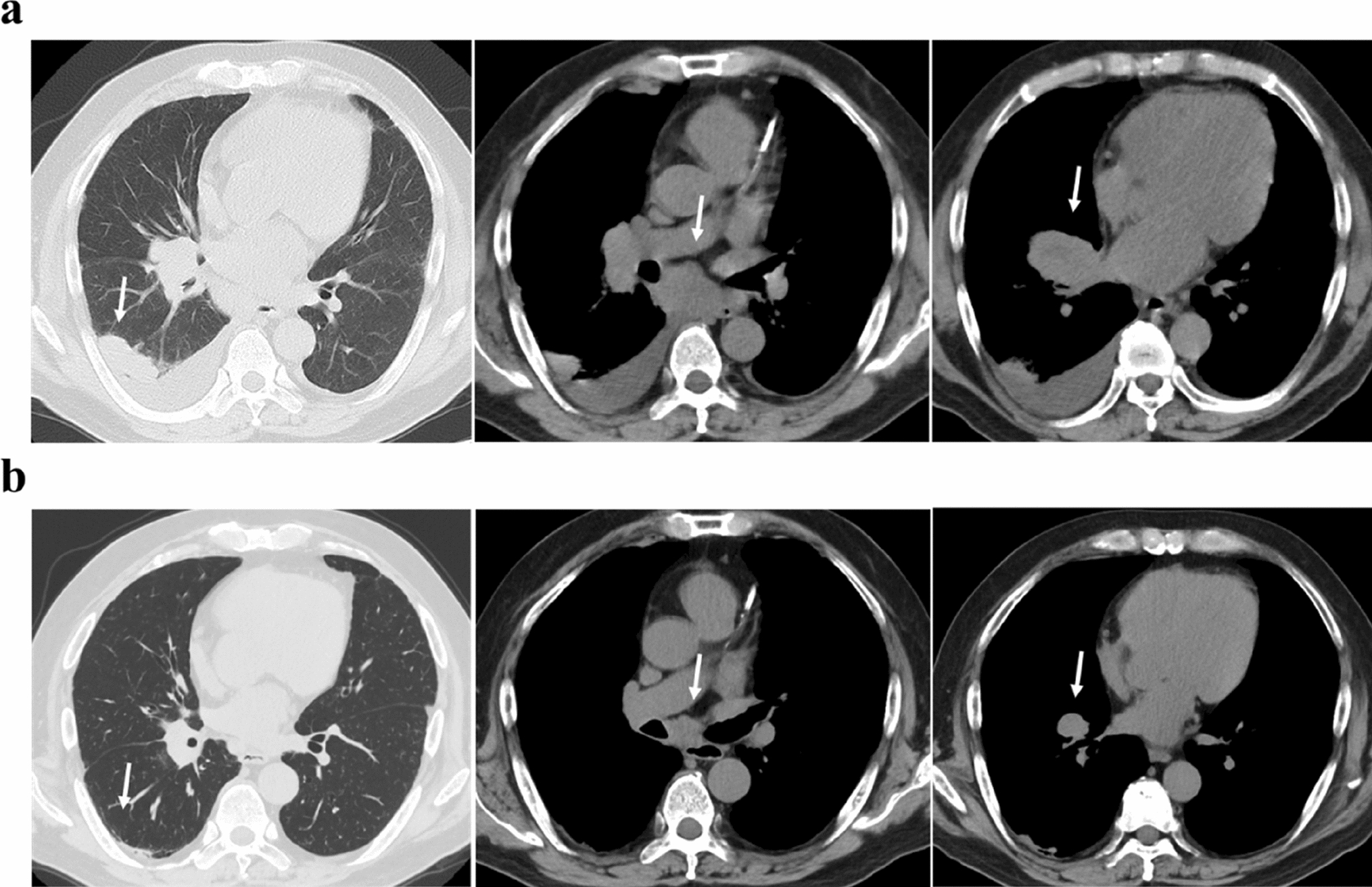 Durvalumab plus carboplatin-etoposide treatment in a patient with small-cell lung cancer on hemodialysis: a case report and literature review