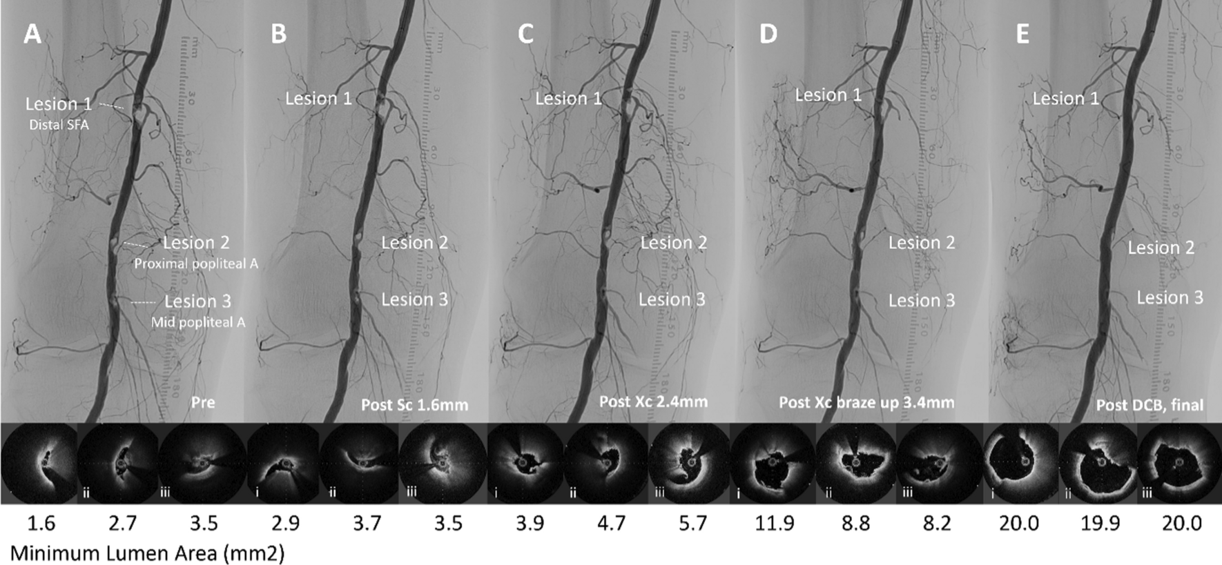 Optical Frequency Domain Imaging to Quantify the Amount of Calcification in Femoropopliteal Artery Lesions Treated with Atherectomy Devices