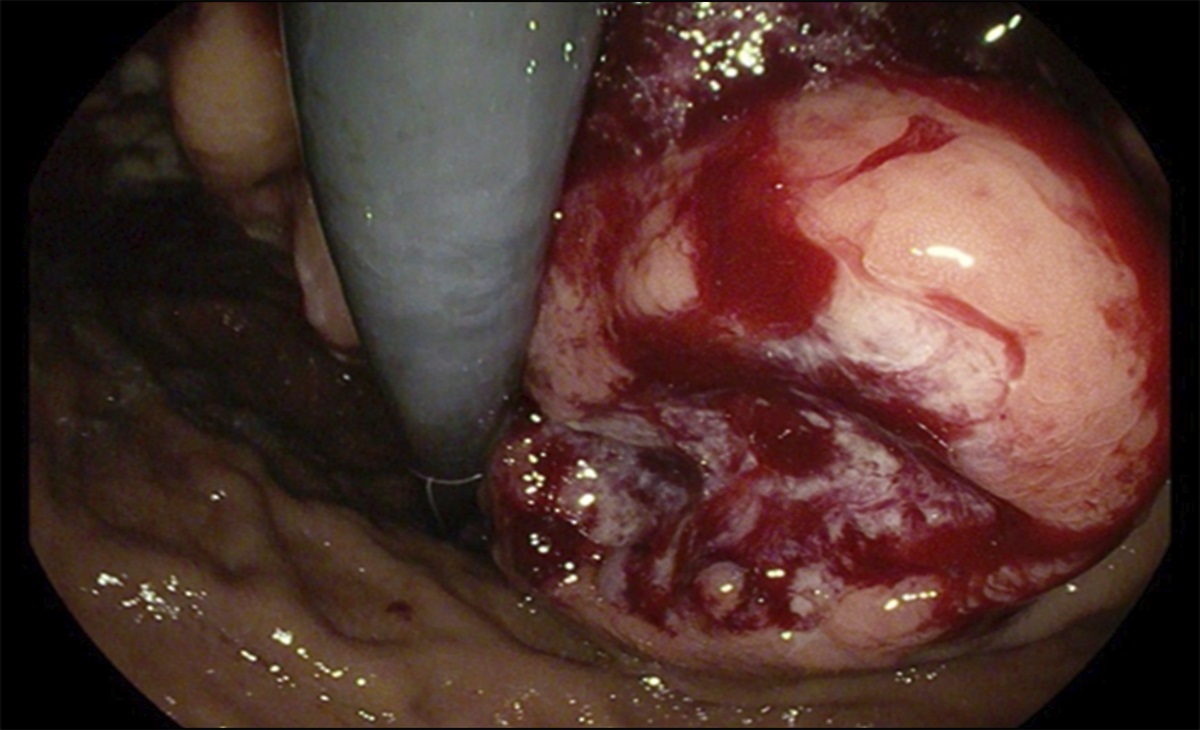 Pancreatic Adenosquamous Carcinoma Presenting as a Gastric Lesion