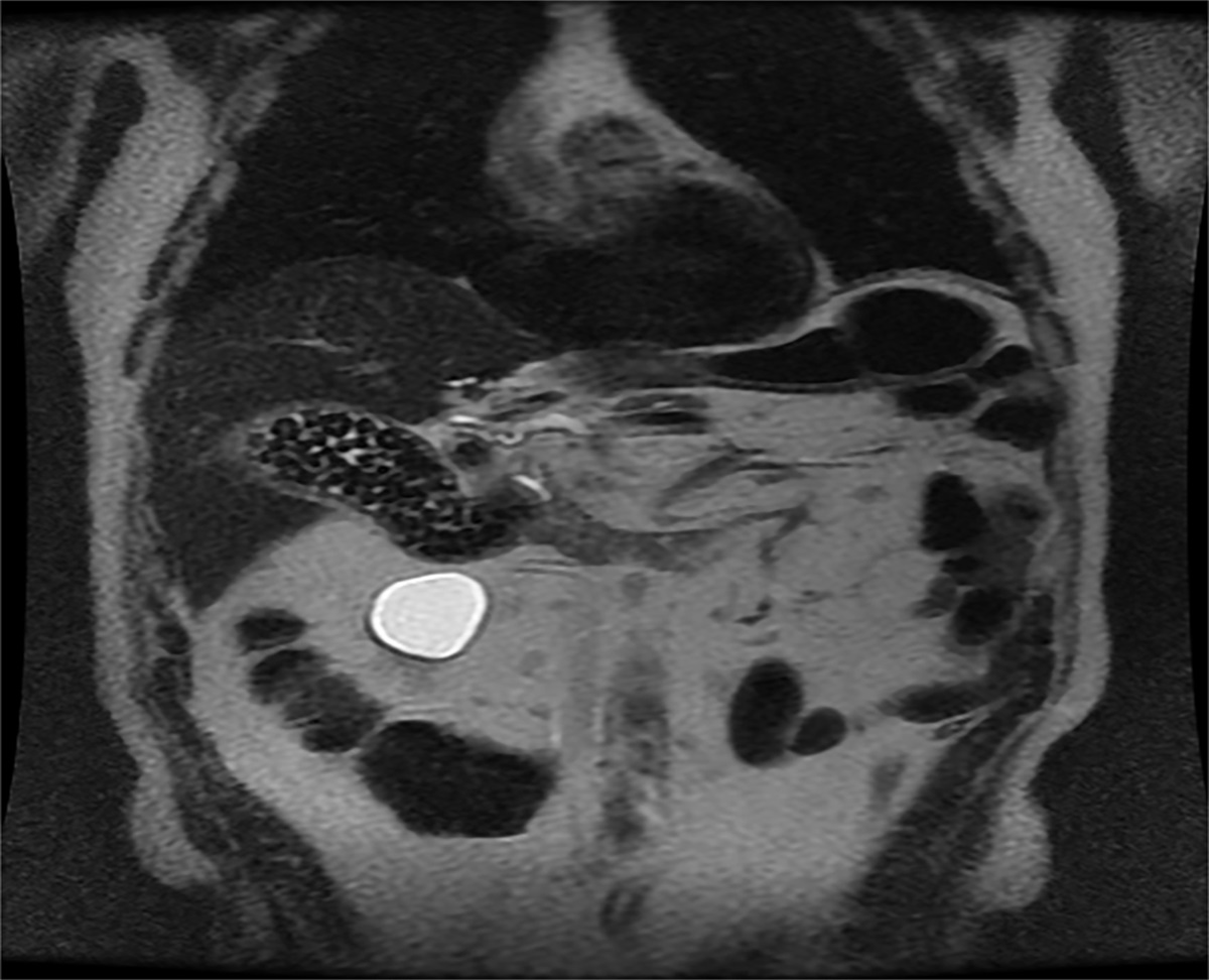 EUS-Guided Cholecystoduodenostomy for a Poor Surgical Candidate With Chronic Octreotide-Associated Gallstones From Metastatic Neuroendocrine Tumor