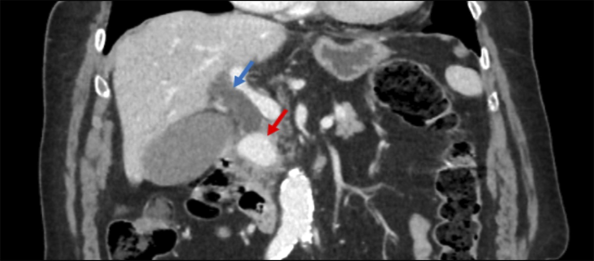 Hepatic Artery Aneurysm Causing Biliary Compression