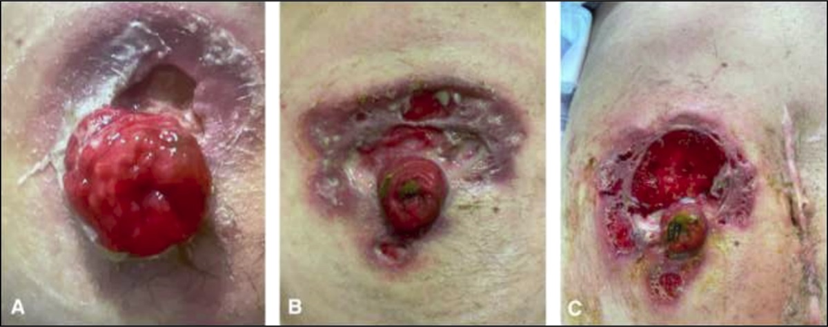 Paradoxical Reaction and Parastomal Pyoderma Gangrenosum Emergence With Secukinumab Therapy