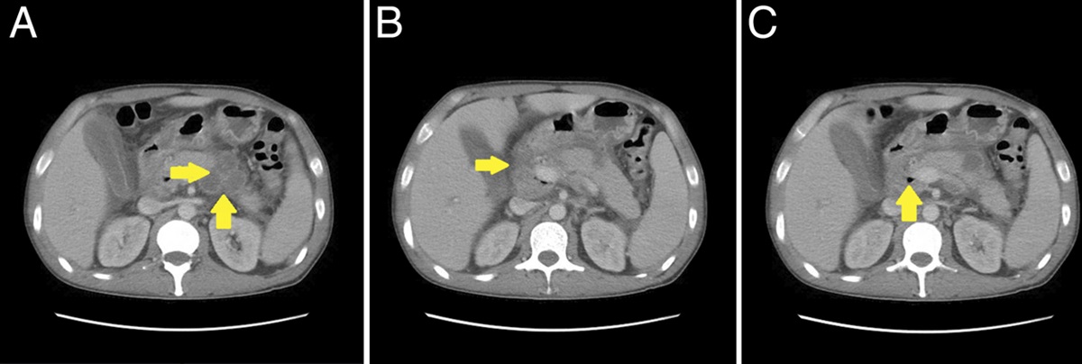 Pancreatic Tuberculosis With Duodenal Fistula Presenting as Life-Threatening Gastrointestinal Bleeding