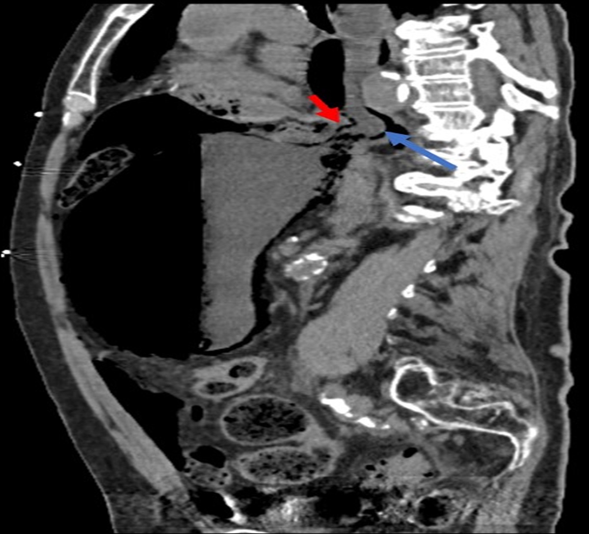 A Rare Case of Emphysematous Gastritis Secondary to Organo-Axial Gastric Volvulus Associated With Sarcina ventriculi
