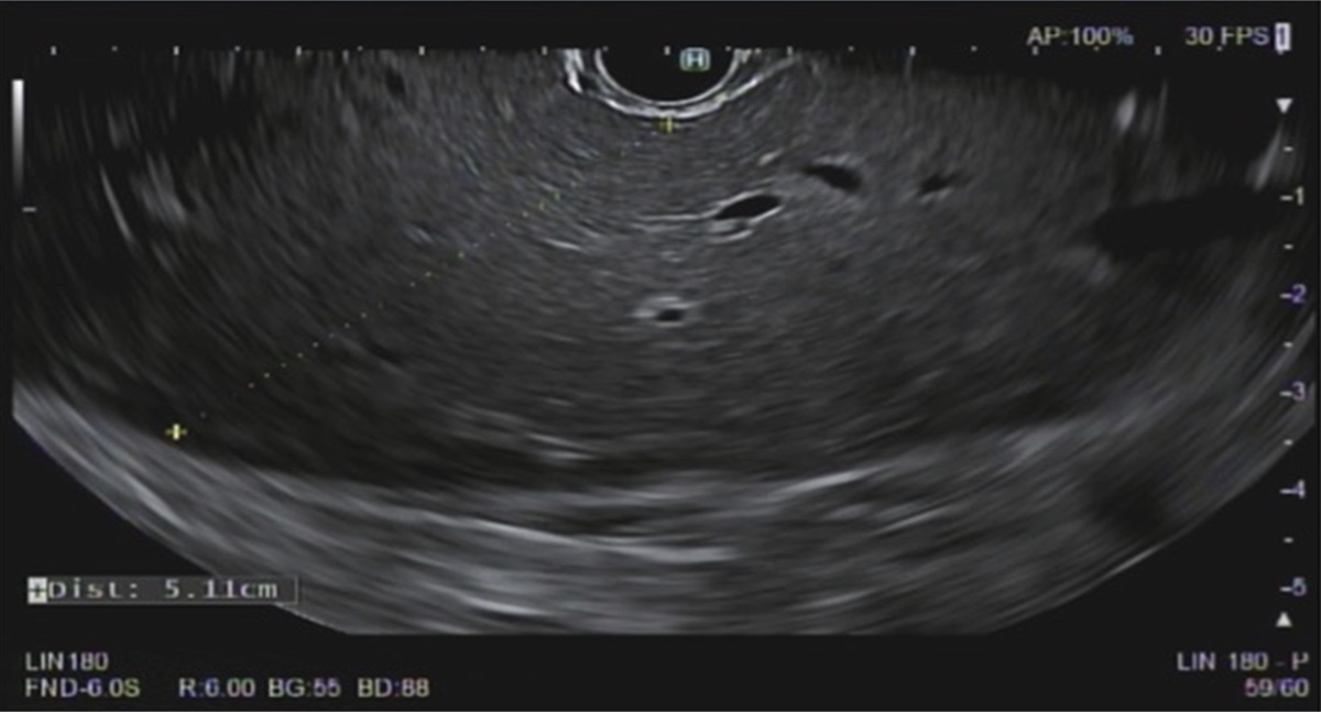 Multiloculated Liver Abscess: A Complication of Endoscopic Ultrasound-Guided Liver Biopsy