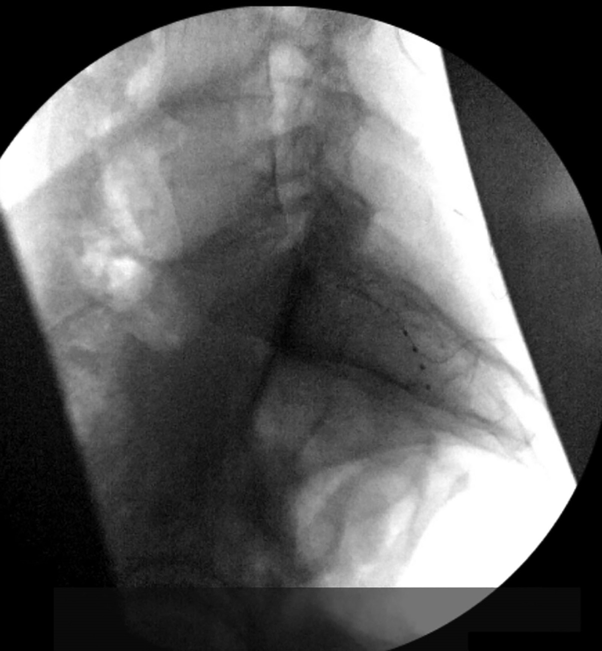 Use of a Sheath and Stylet for a Difficult Dorsal Root Ganglion Stimulation Lead Extraction: A Case Report