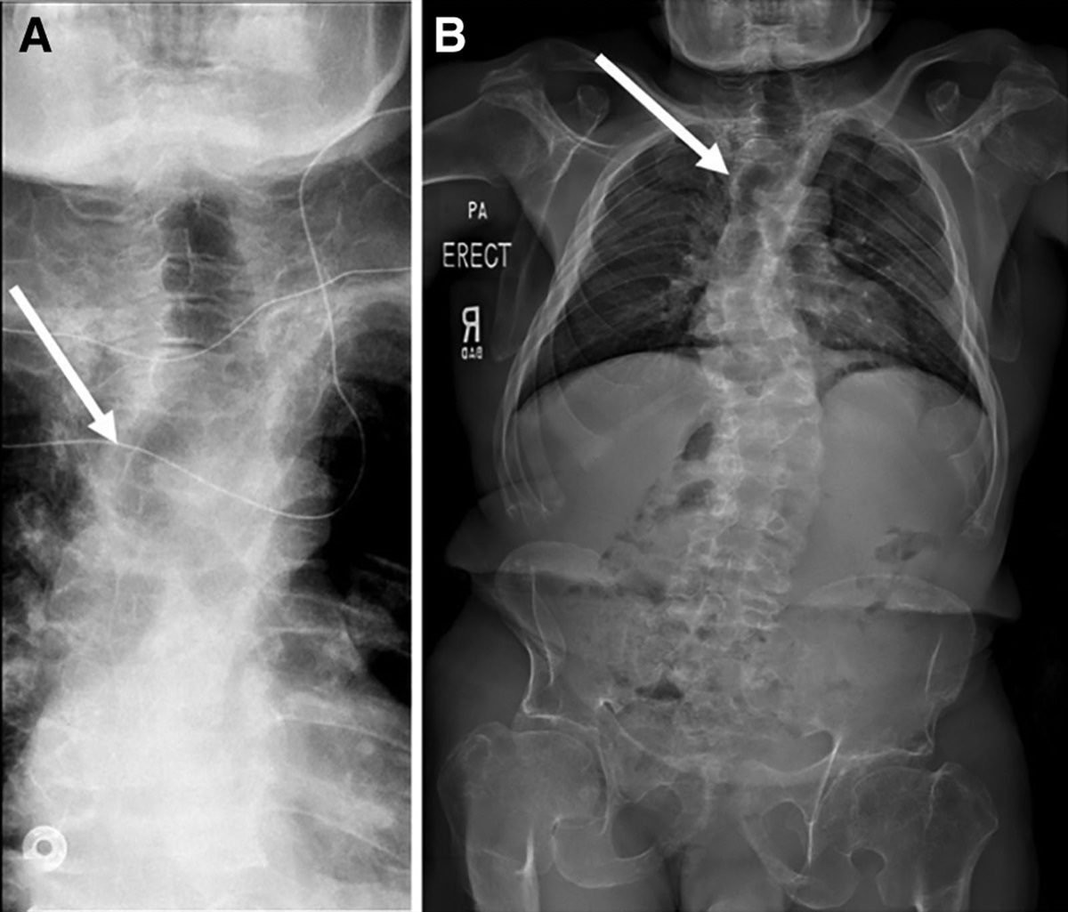 Severe Multilevel Tracheal Stenosis with Significant Twisting in a Patient with Spondylometaphyseal Dysplasia: A Case Report