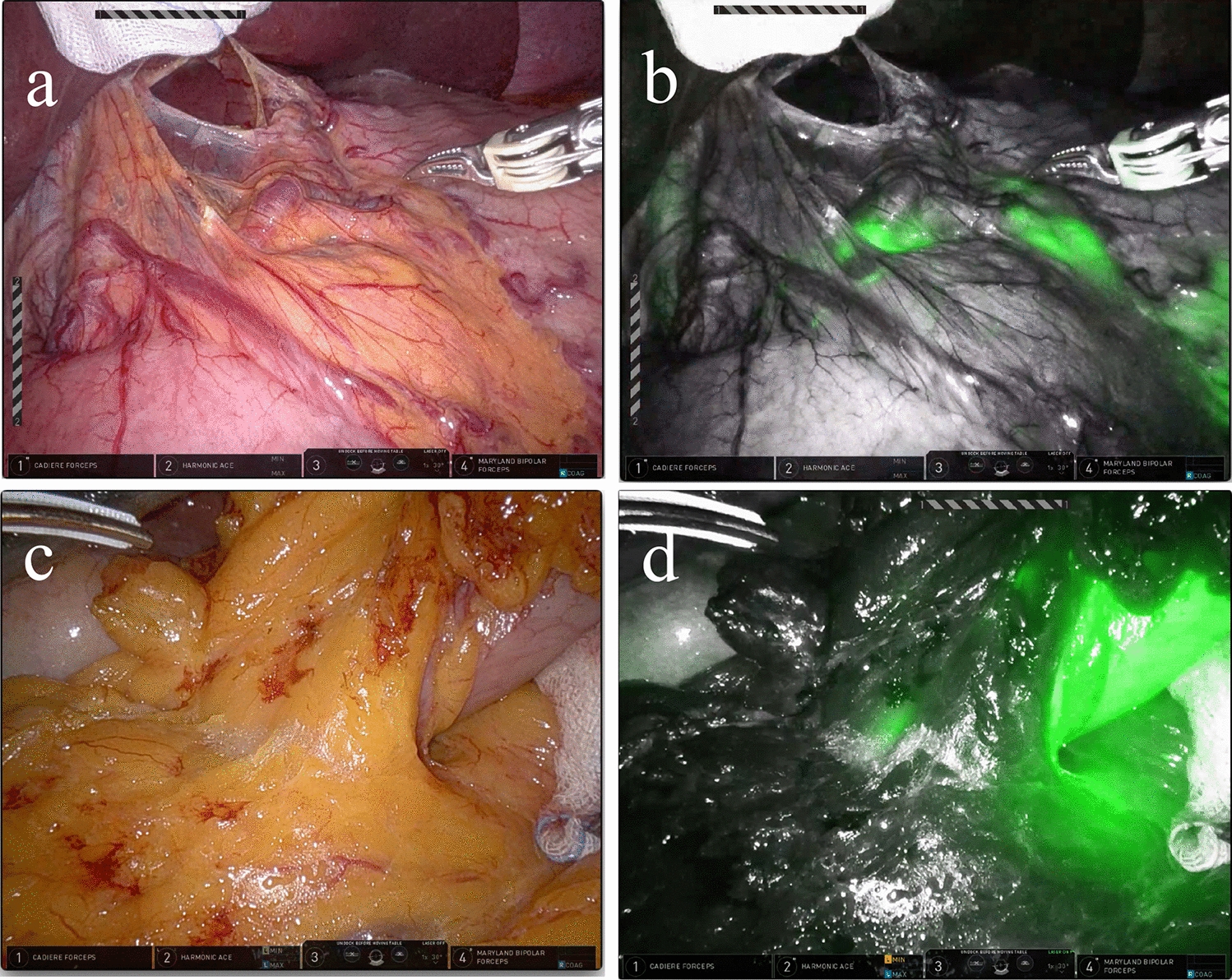 Superior lymph node harvest by fluorescent lymphography during minimally invasive gastrectomy for gastric cancer patients with high body mass index