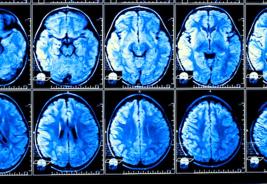 Human brains are getting larger. That may be good news for dementia risk