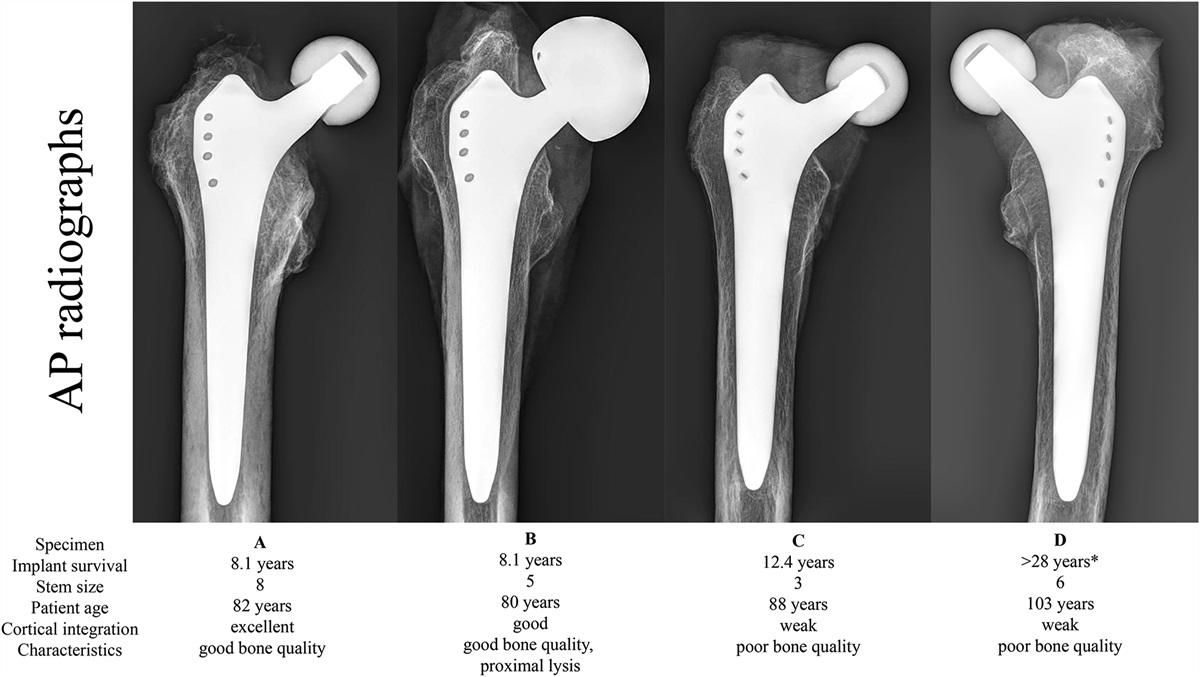 Three-Dimensional Osseointegration Patterns of Cementless Femoral Stems: An ex Vivo Study with High-Resolution Imaging and Histological Evaluation