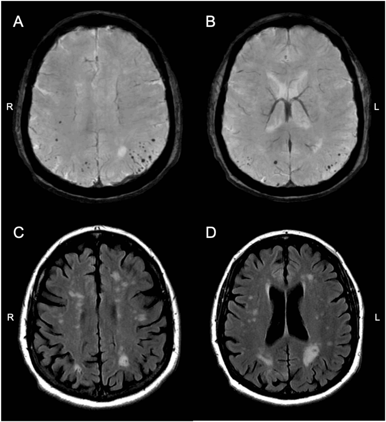 Lobar Microbleeds in the Posterior Cortical Atrophy Syndrome: A Comparison to Typical Alzheimer’s Disease