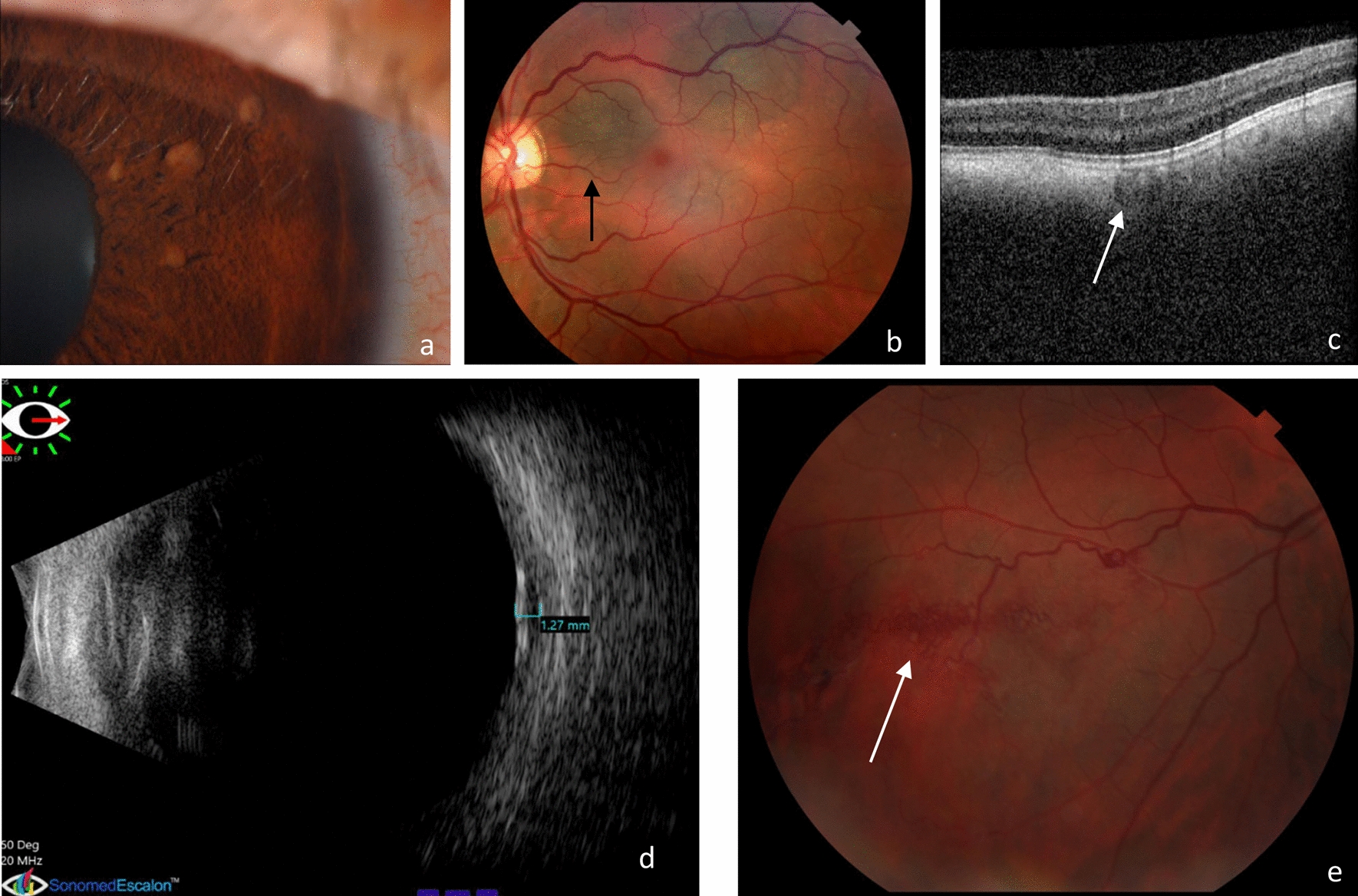 Histologic correlates of “Choroidal abnormalities” in Neurofibromatosis type 1 (NF1)