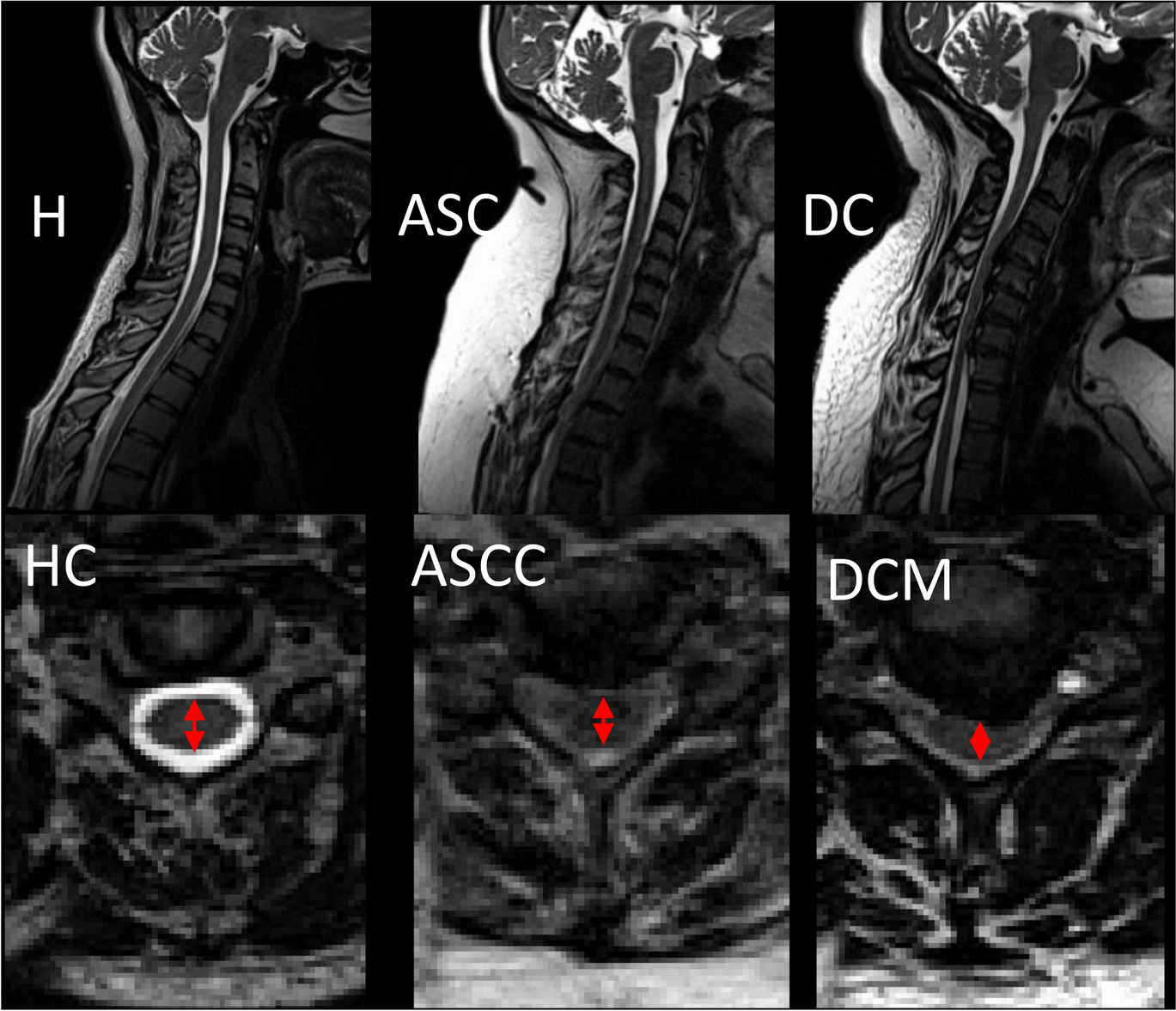 Early neurological changes in aging cervical spine: insights from PROMIS mobility assessment