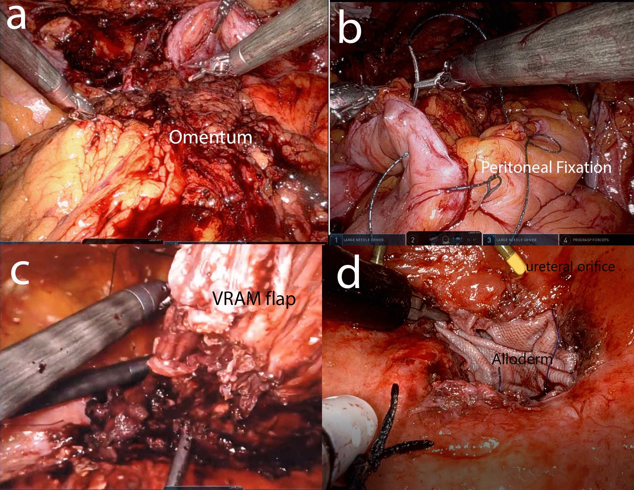 Flaps and Grafts in Robotic Reconstructive Surgery