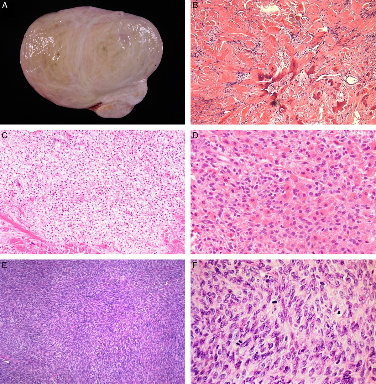 Sex Cord–Stromal Tumors of the Ovary: An Update and Review. Part I—Pure Ovarian Stromal Tumors