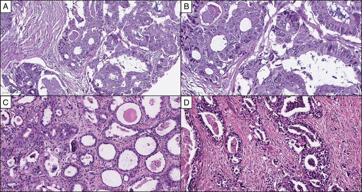 Glandular Lesions of the Urinary Bladder: Diagnostic and Molecular Updates