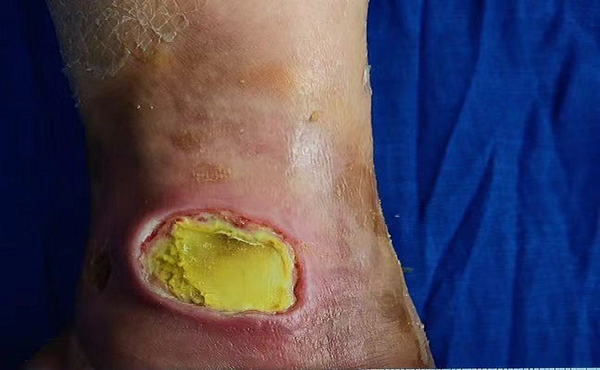 The Management of Chronic Graft-Versus-Host Disease Skin Ulcers after Hematopoietic Stem Cell Transplantation: A Case Report