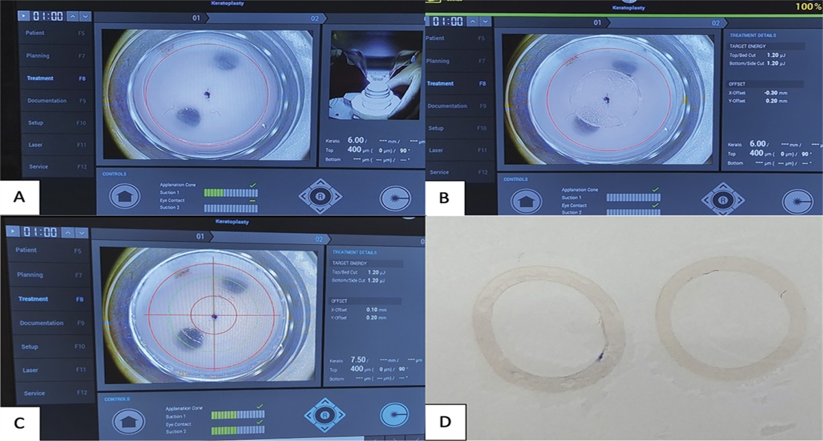 Technique of corneal allogenic ring segment preparation using femtosecond laser: preclinical study on human corneal grafts