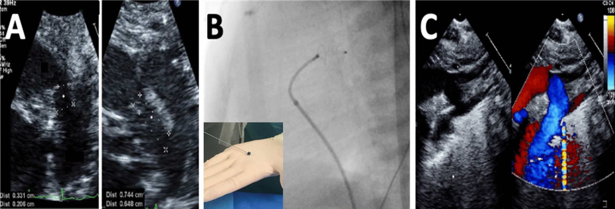 Post-ligation cardiac syndrome after surgical versus transcatheter closure of patent ductus arteriosus in low body weight premature infants: a multicenter retrospective cohort study