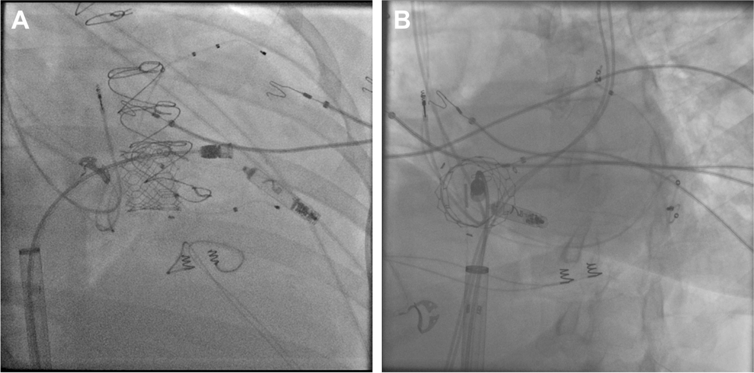 Helix-fixed leadless pacemaker implantation through a valve-in-valve tricuspid prosthesis via the femoral approach