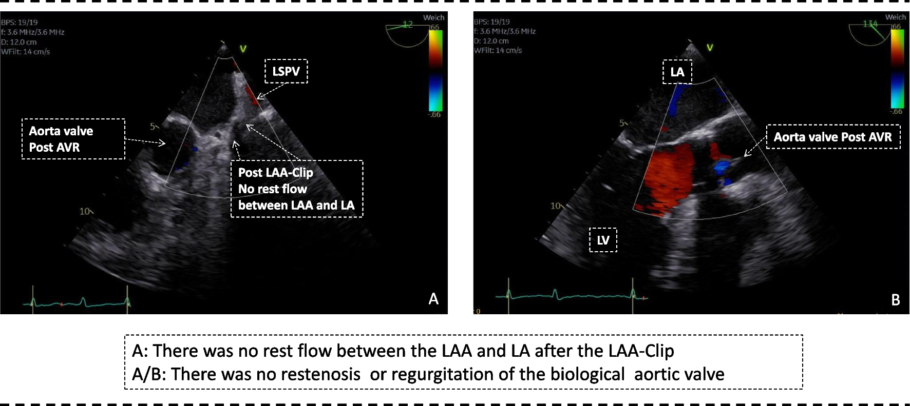 Pulsed field ablation for atrial fibrillation when in proximity to LAA AtriClip: the LAA-Clip does not inhibit the pulse