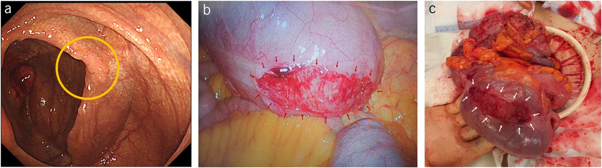 Serosal Tear After Diagnostic and Subsequent Therapeutic Colonoscopy: A Rare Complication