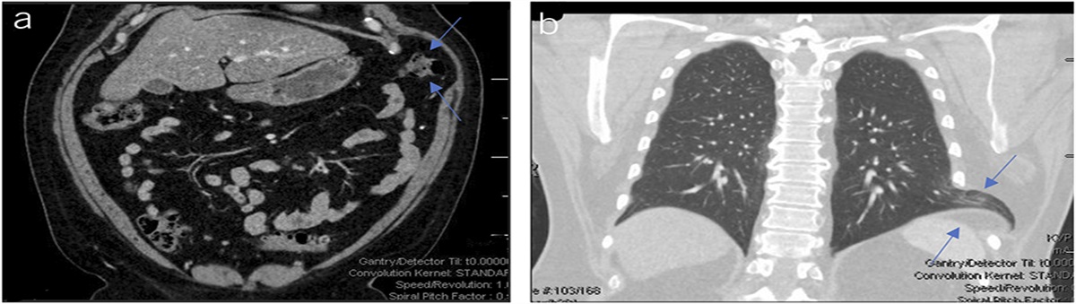 Cough With a Pop: A Rare Case of Acquired Abdominal Intercostal Hernia