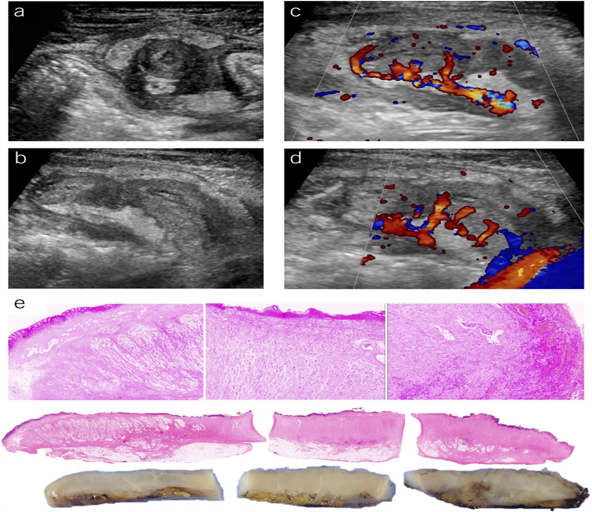 Utility of Abdominal Ultrasound in the Preoperative Diagnosis of Appendiceal Goblet Cell Adenocarcinoma