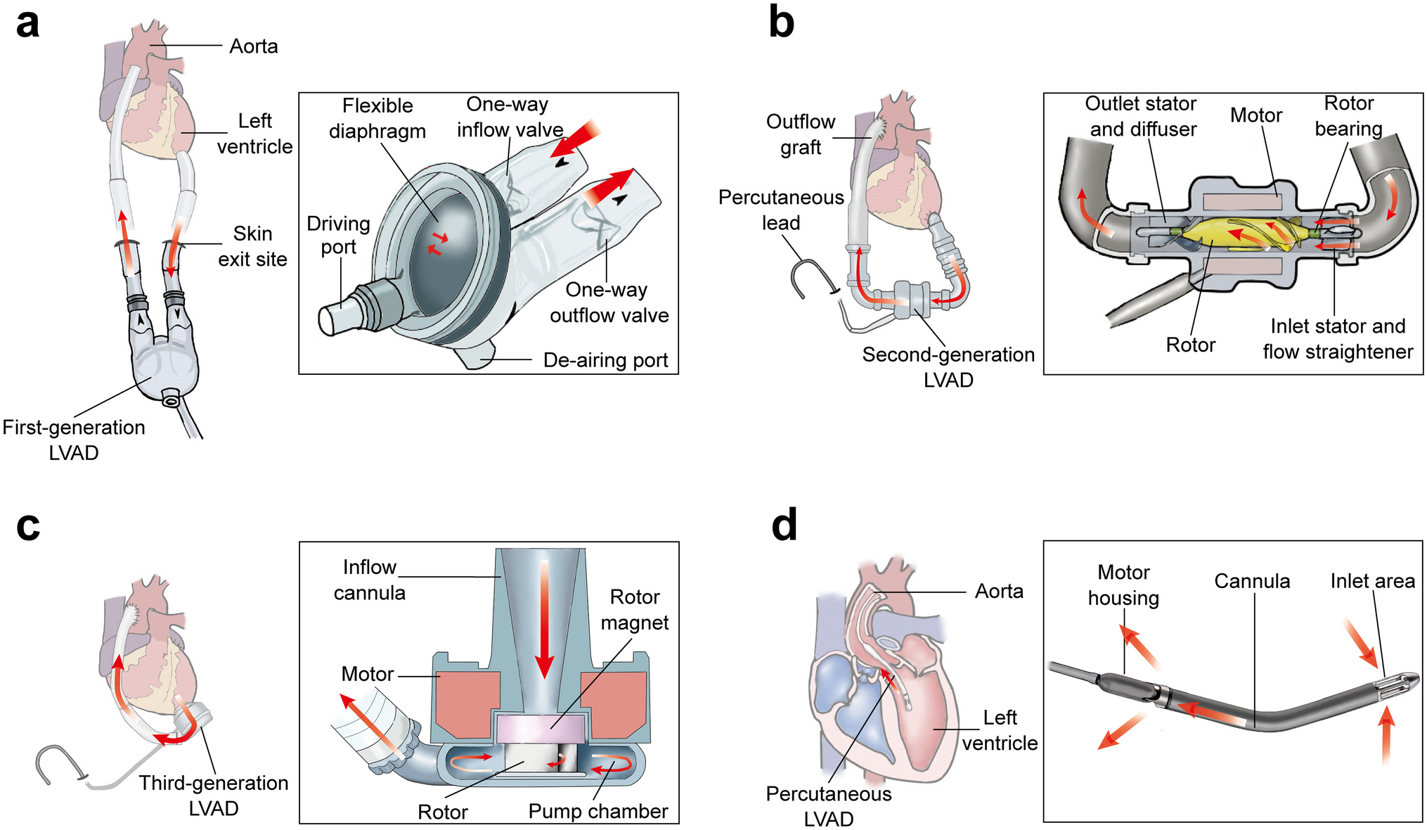 Current status and future directions in pediatric ventricular assist device