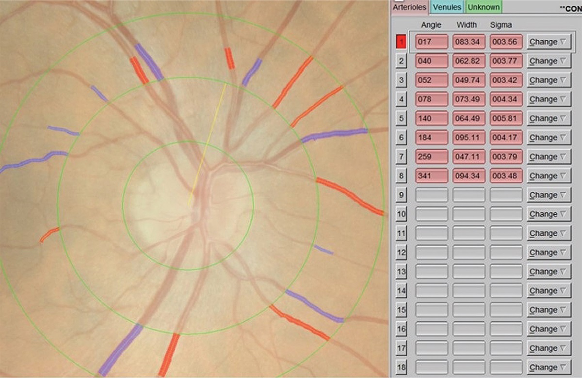 Retinal artery to vein ratio is associated with cerebral microbleeds in individuals with type 1 diabetes