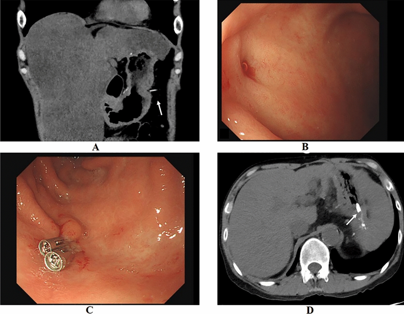 Sinus Formation and Subsequent Bleeding After Splenectomy