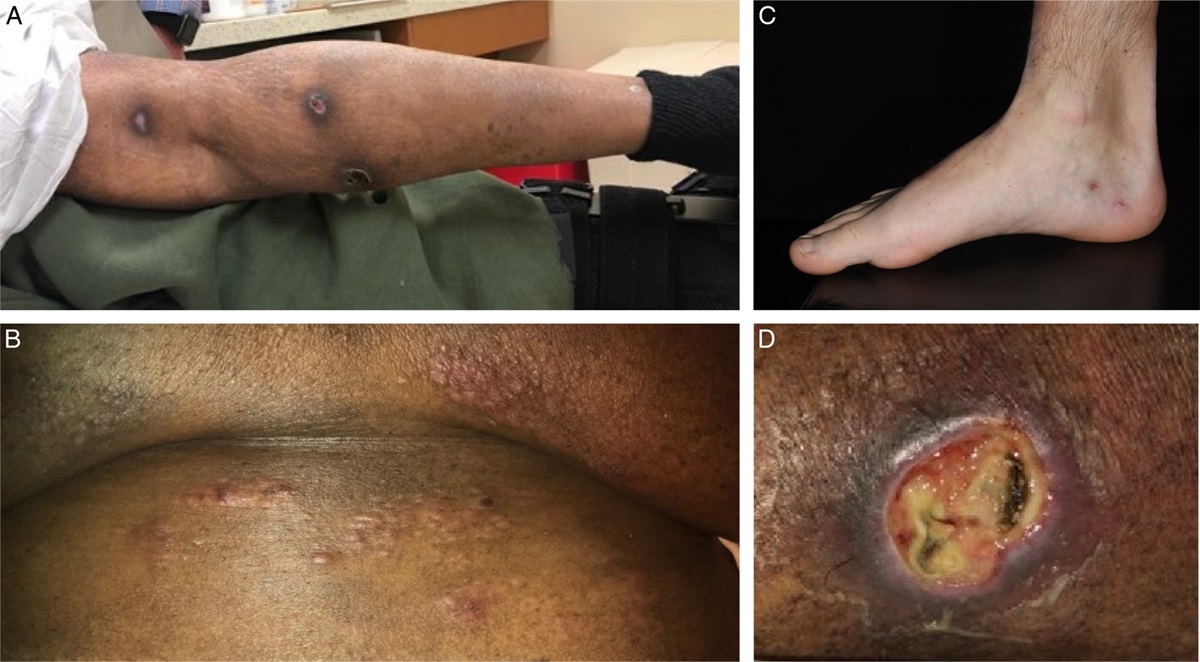Lymphomatoid Papulosis With T-cell Receptor–Gamma Delta Expression: A Clinicopathologic Case-series of 26 Patients of an Underrecognized Immunophenotypic Variant of Lymphomatoid Papulosis