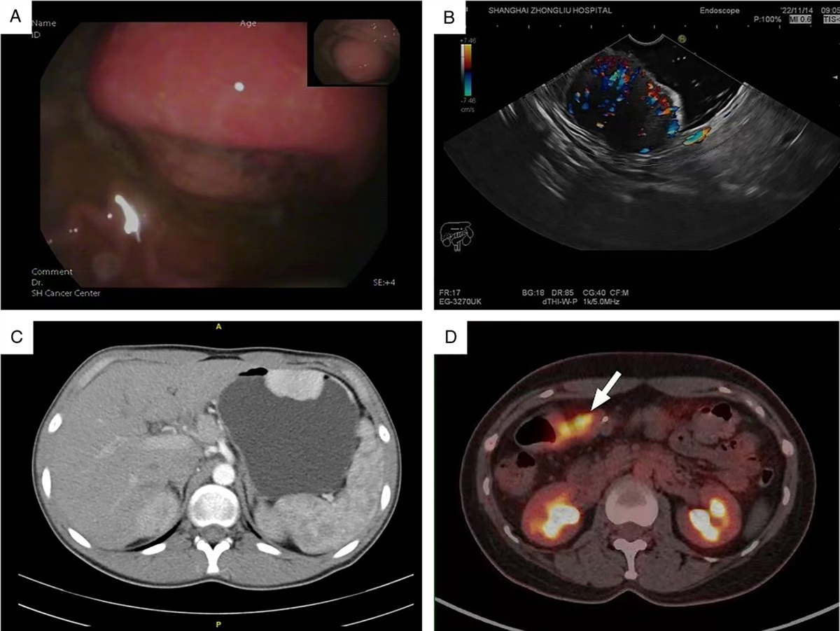 Primary NTRK-rearranged Spindle Cell Neoplasm of the Gastrointestinal Tract: A Clinicopathological and Molecular Analysis of 8 Cases