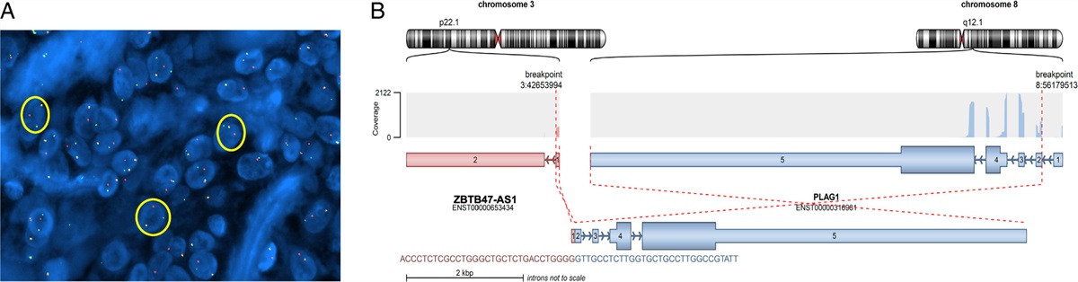 Characterization of a Molecularly Distinct Subset of Oncocytic Pleomorphic Adenomas/Myoepitheliomas Harboring Recurrent ZBTB47-AS1::PLAG1 Gene Fusion